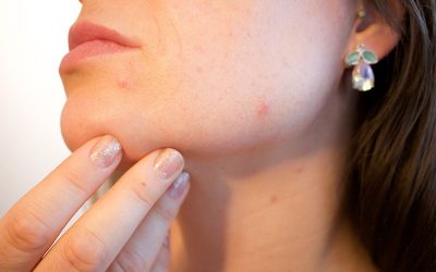 Acne Medication From Your Dermatologist